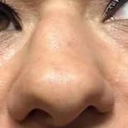 هزینه عمل بینی پهن و گوشتی