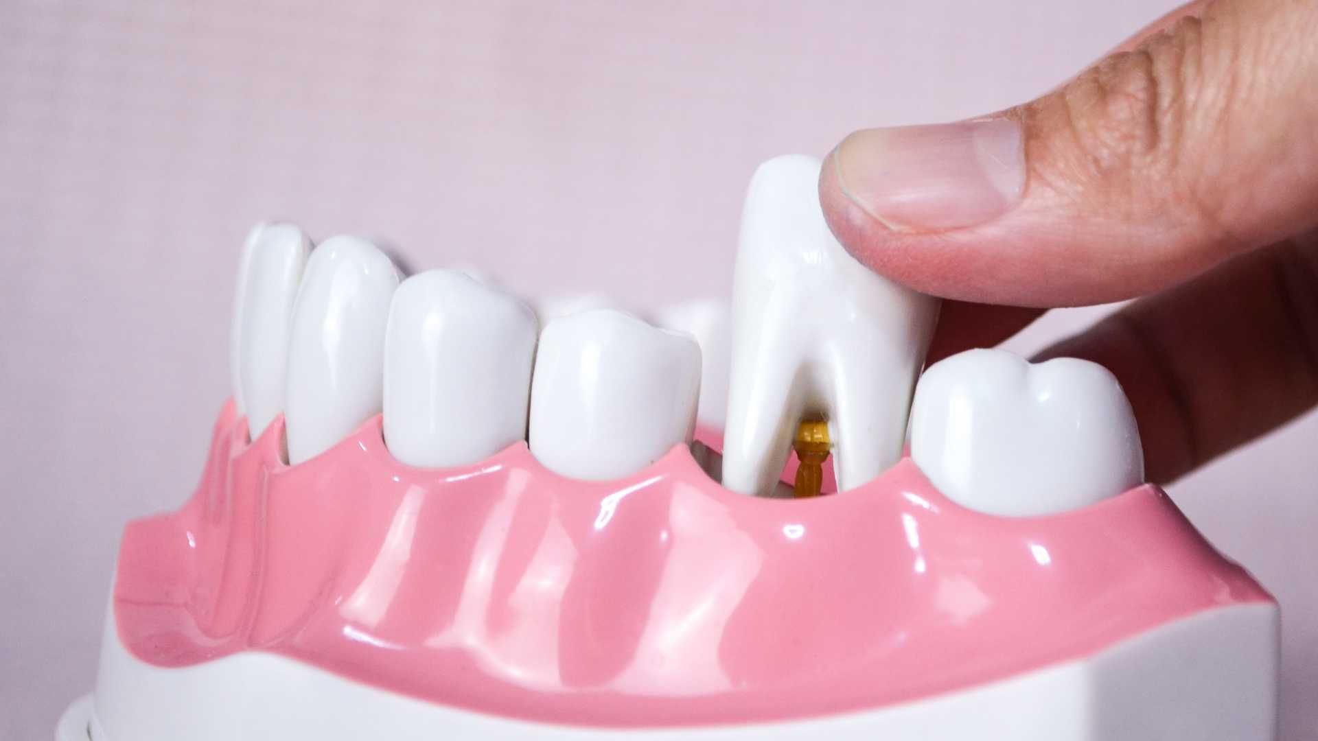 کشیدن دندان جلویی (بدون جراحی)