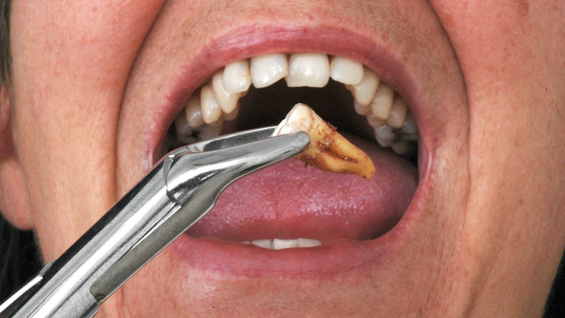 کشیدن دندان عقل (بدون جراحی)