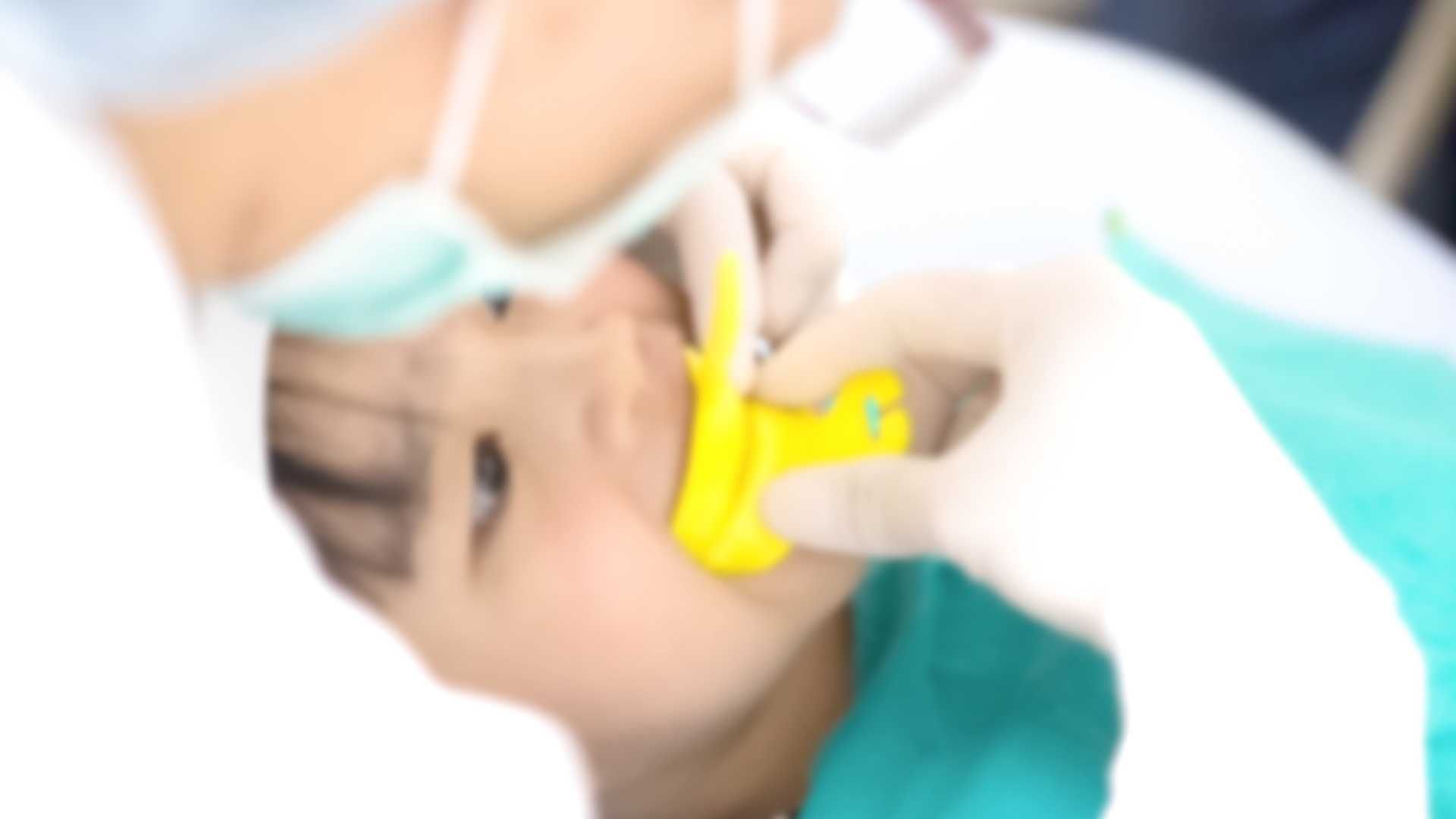 فیشور سیلانت هر دندان با مواد فلو سرامیک (اطفال)