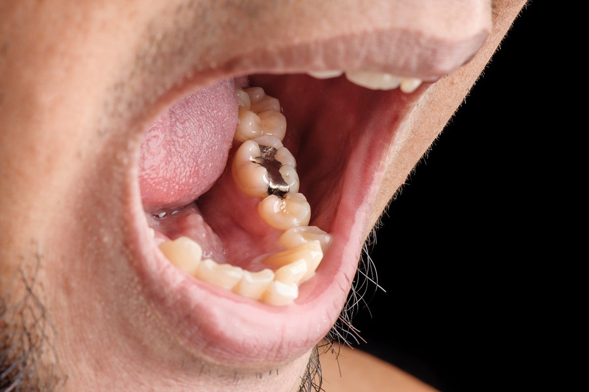 پرکردن دندان دو سطحی با آمالگام دکتر سهیل جابری نسب در تهران 1
