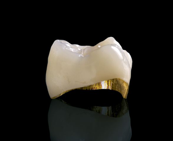 روکش دندان pfm (هر واحد)