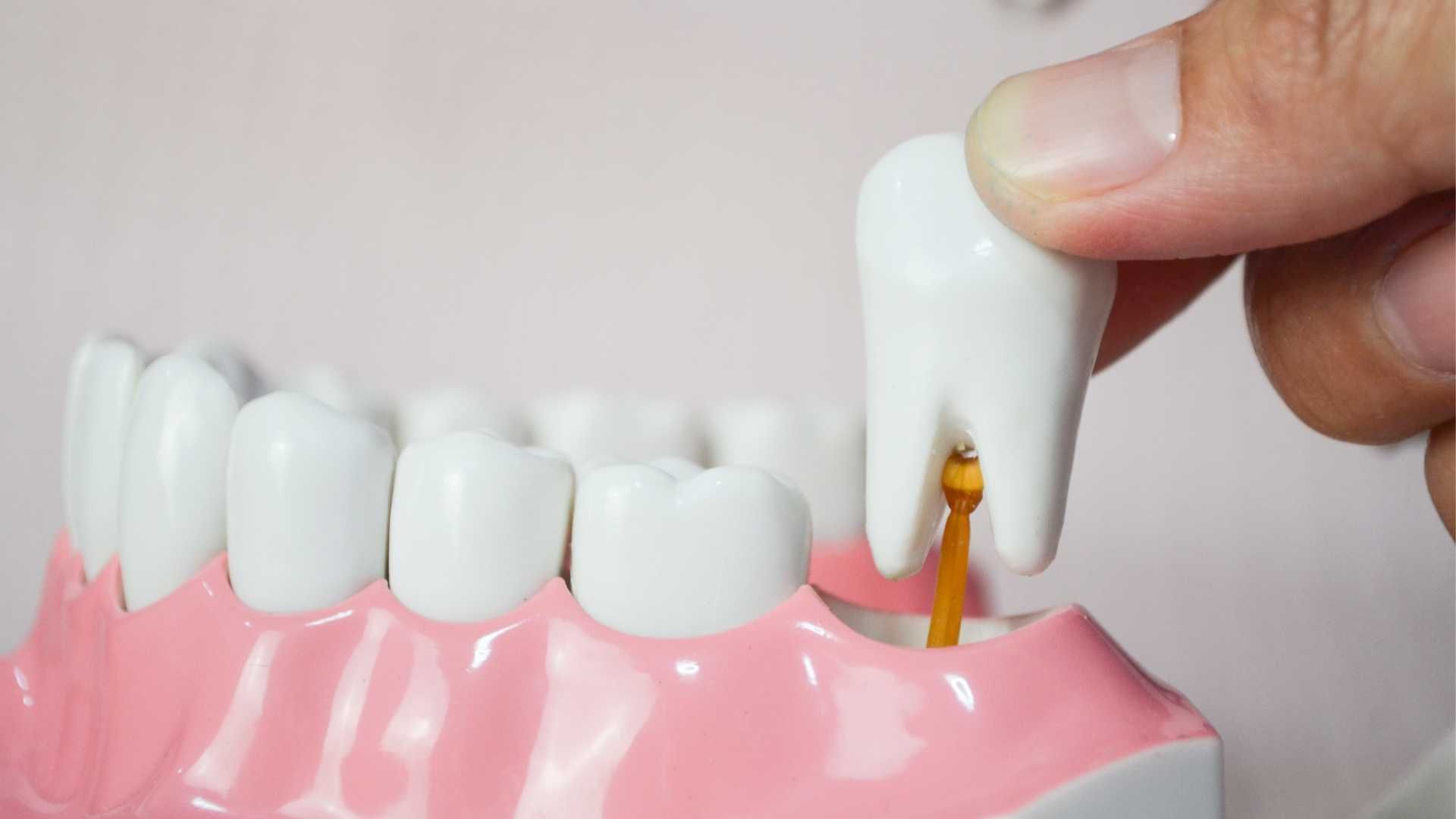 کشیدن ریشه دندان جلویی (بدون جراحی)