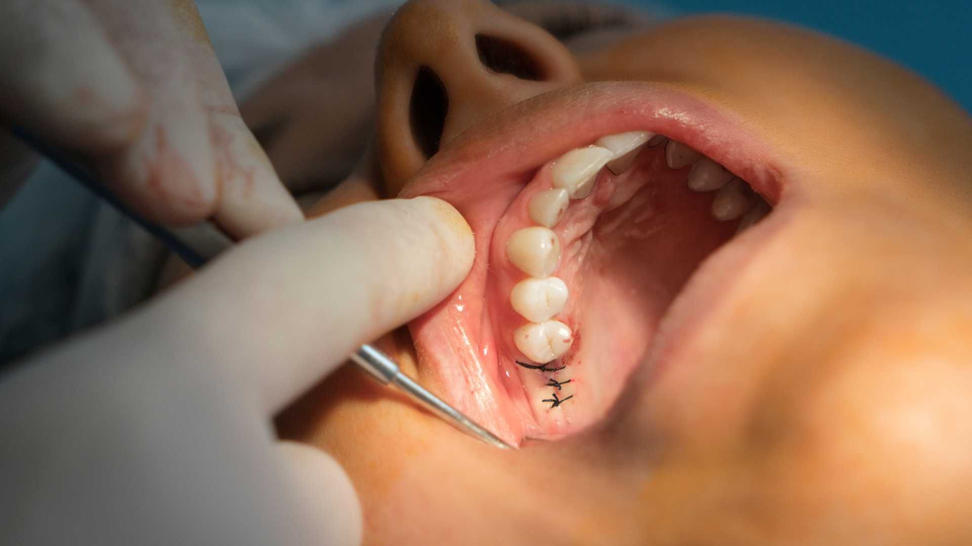 عصب کشی دندان 1 کانال