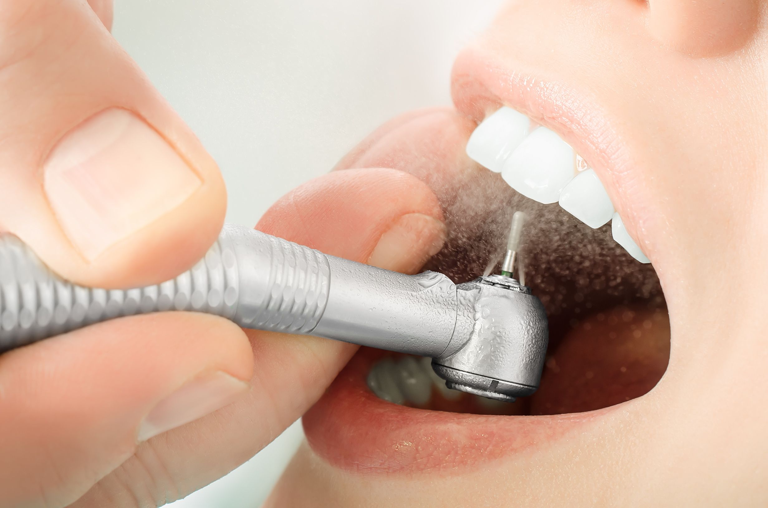 پرکردن دندان یک سطحی با کامپوزیت سوئیسی