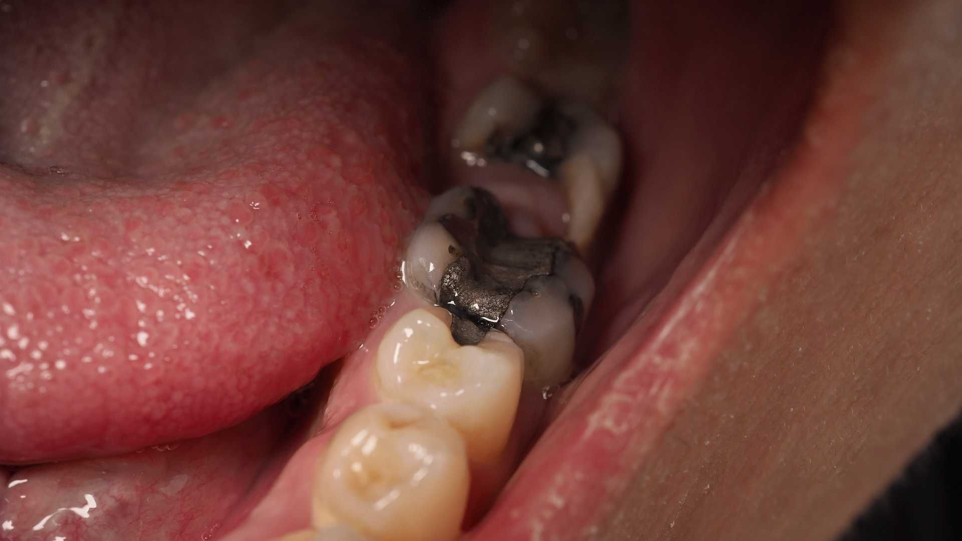 پرکردن دندان سه سطحی با آمالگام دکتر مریم احدی در شیراز 1