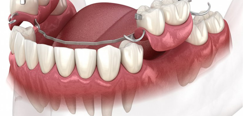 دندان پروتز متحرک پارسیل اکلیلی (تا 3 دندان) دکتر کاملیا علیجانی در تهران 1