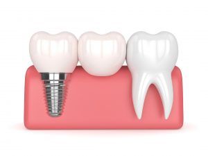 پروتز ثابت (بریج) هر واحد دکتر مرضیه سرانجام در شیراز 1