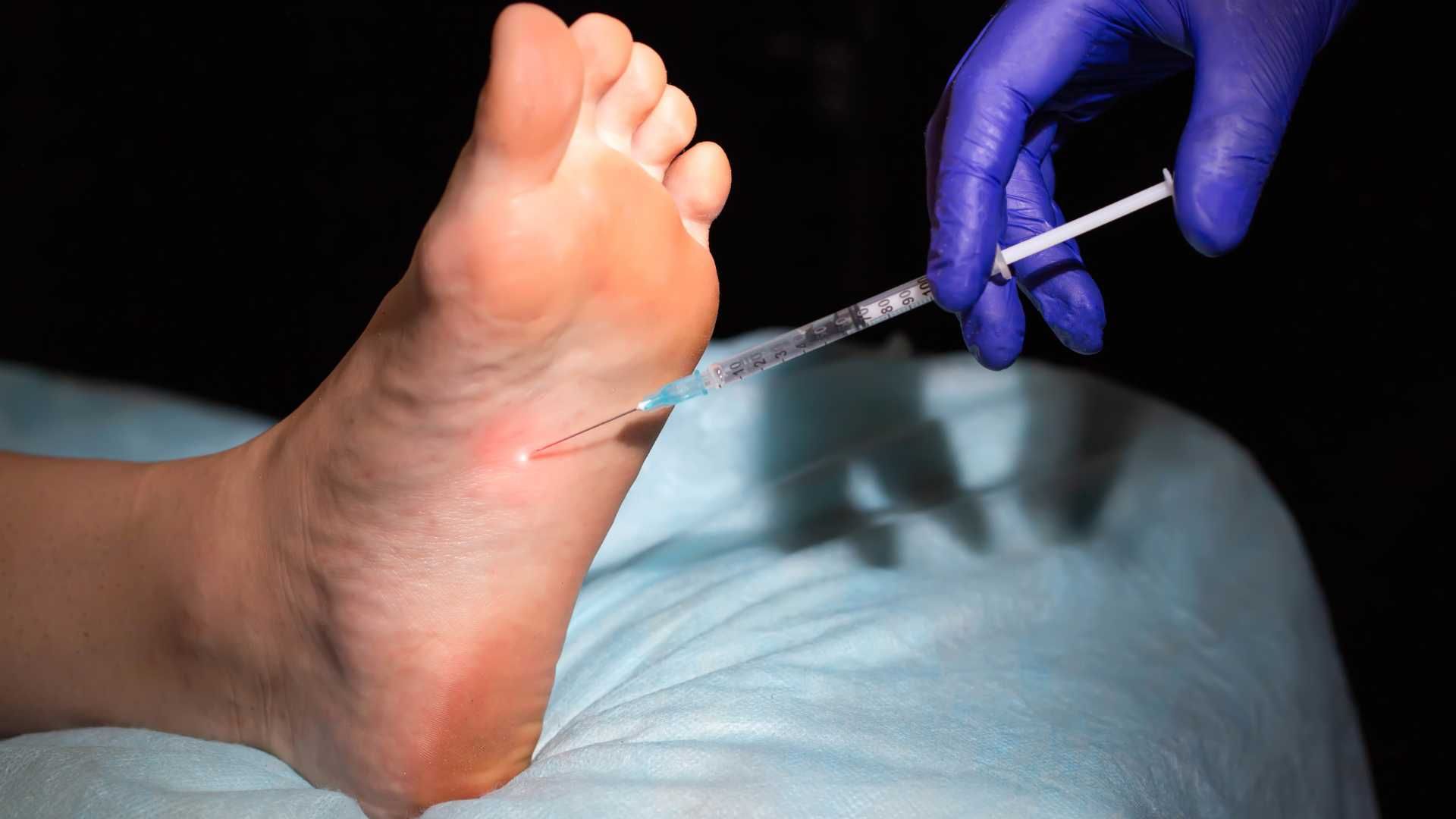 تزریق بوتاکس جهت کاهش تعریق کف پا با برند مصپورت