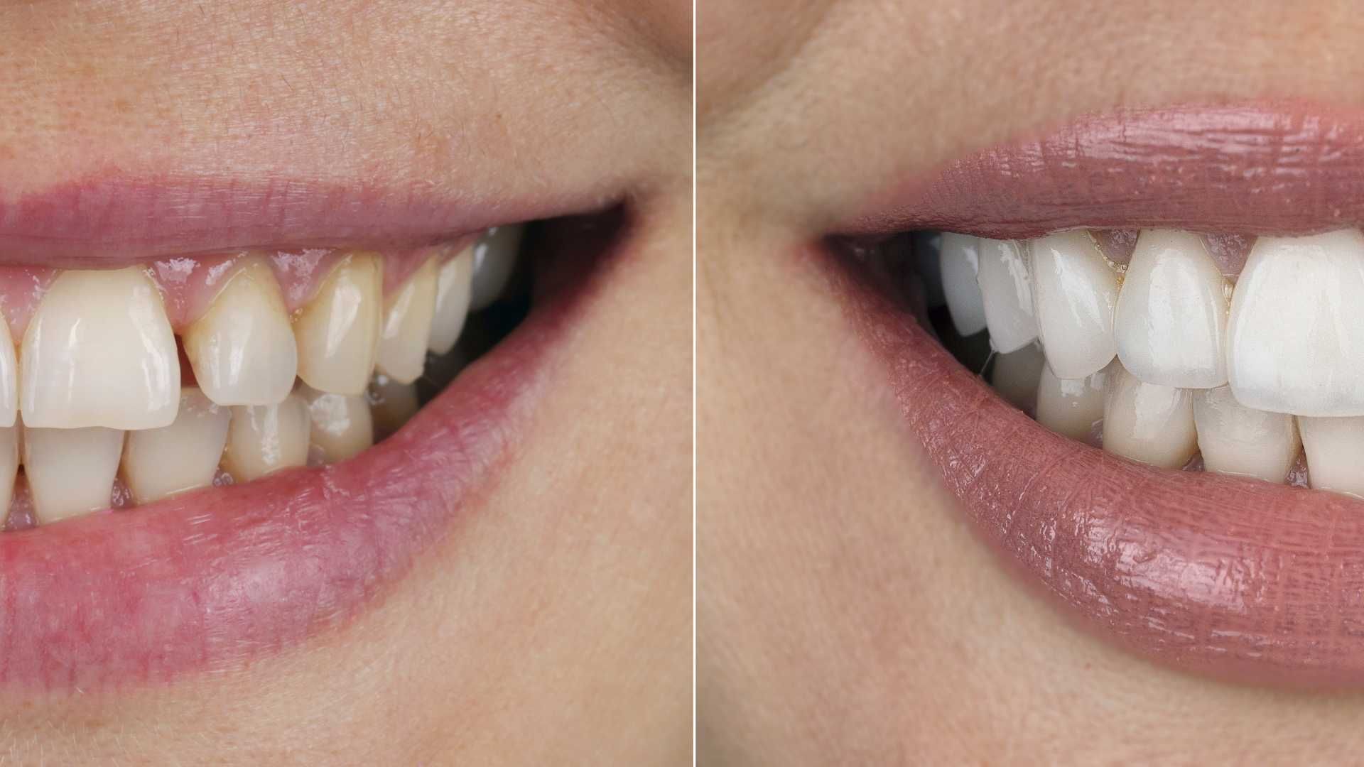 پر کردن دندان یک سطحی با کامپوزیت ژاپنی