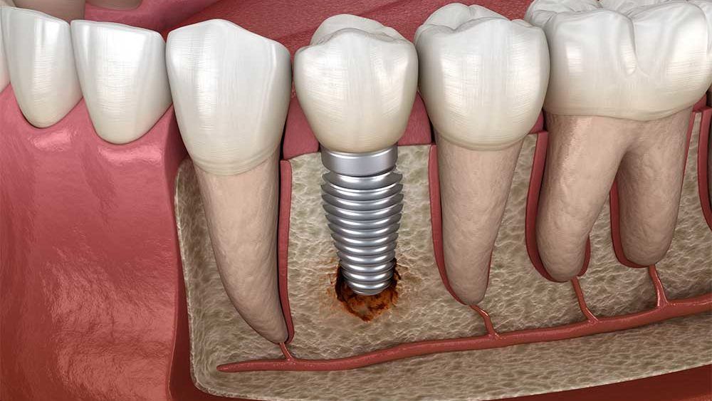 جراحی ایمپلنت،FIXTURE(هر واحد کره ای)