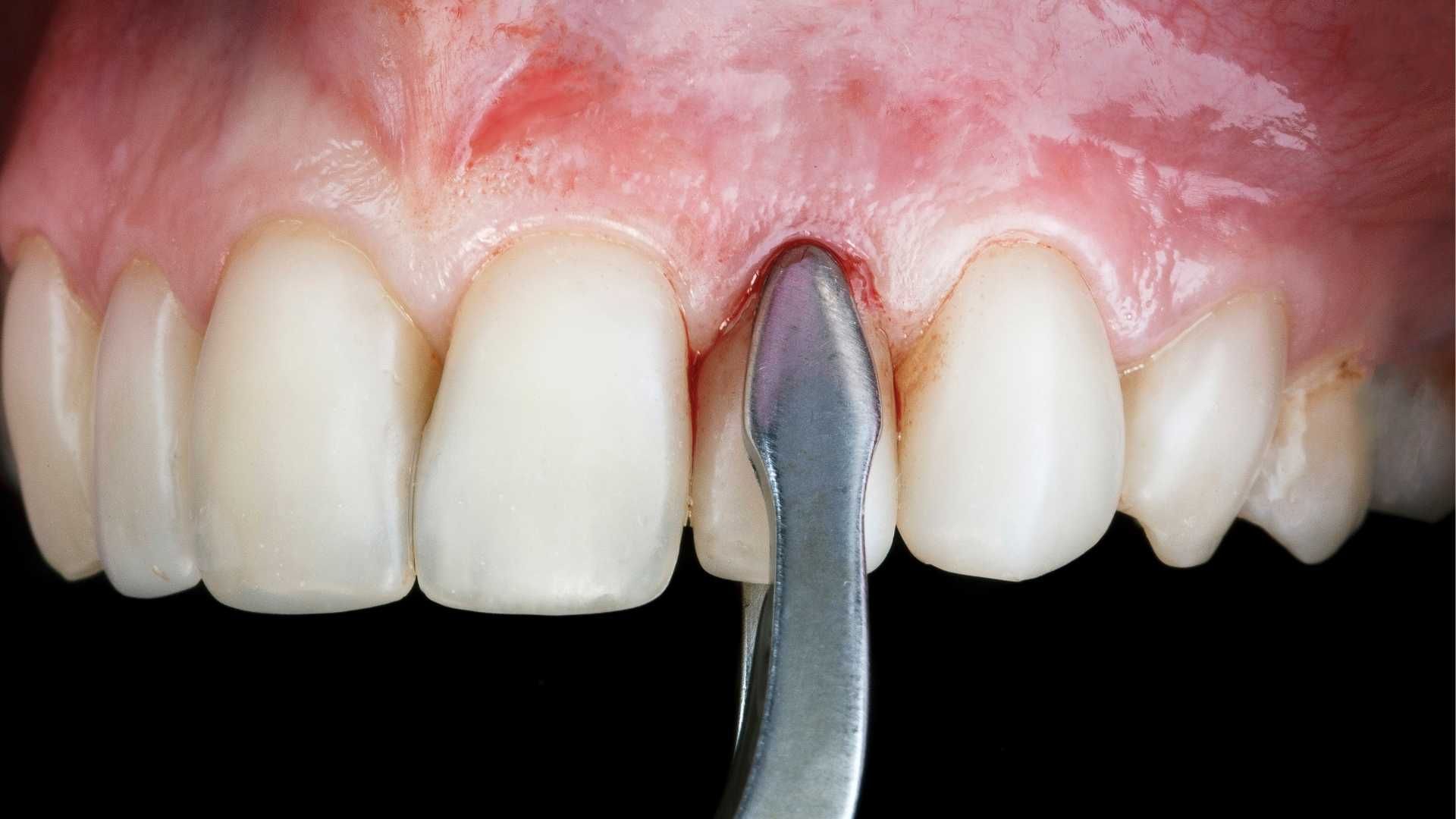 کشیدن دندان قدامی (بدون جراحی)