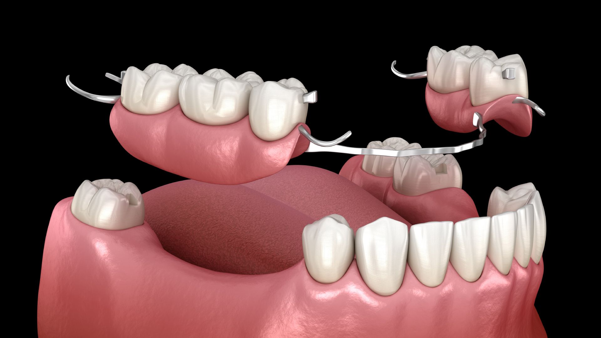دندان پروتز متحرک پارسیل (دندان مصنوعی تکه ای) (هر فک)