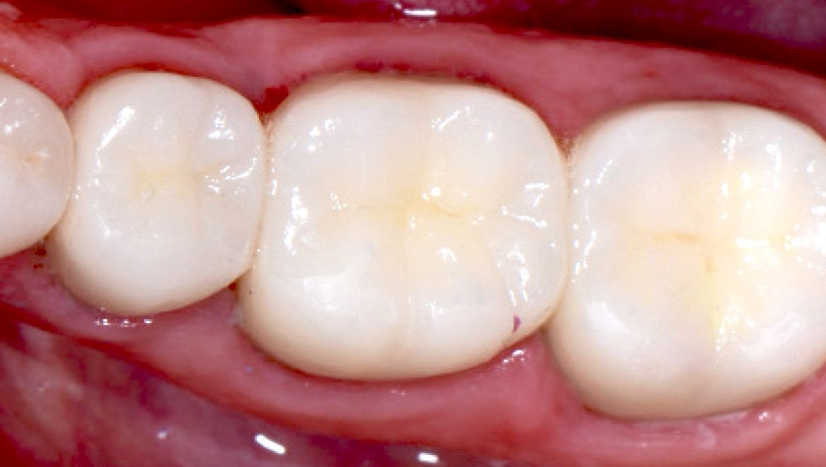 پرکردن دندان سه سطحی با کامپوزیت آلمانی