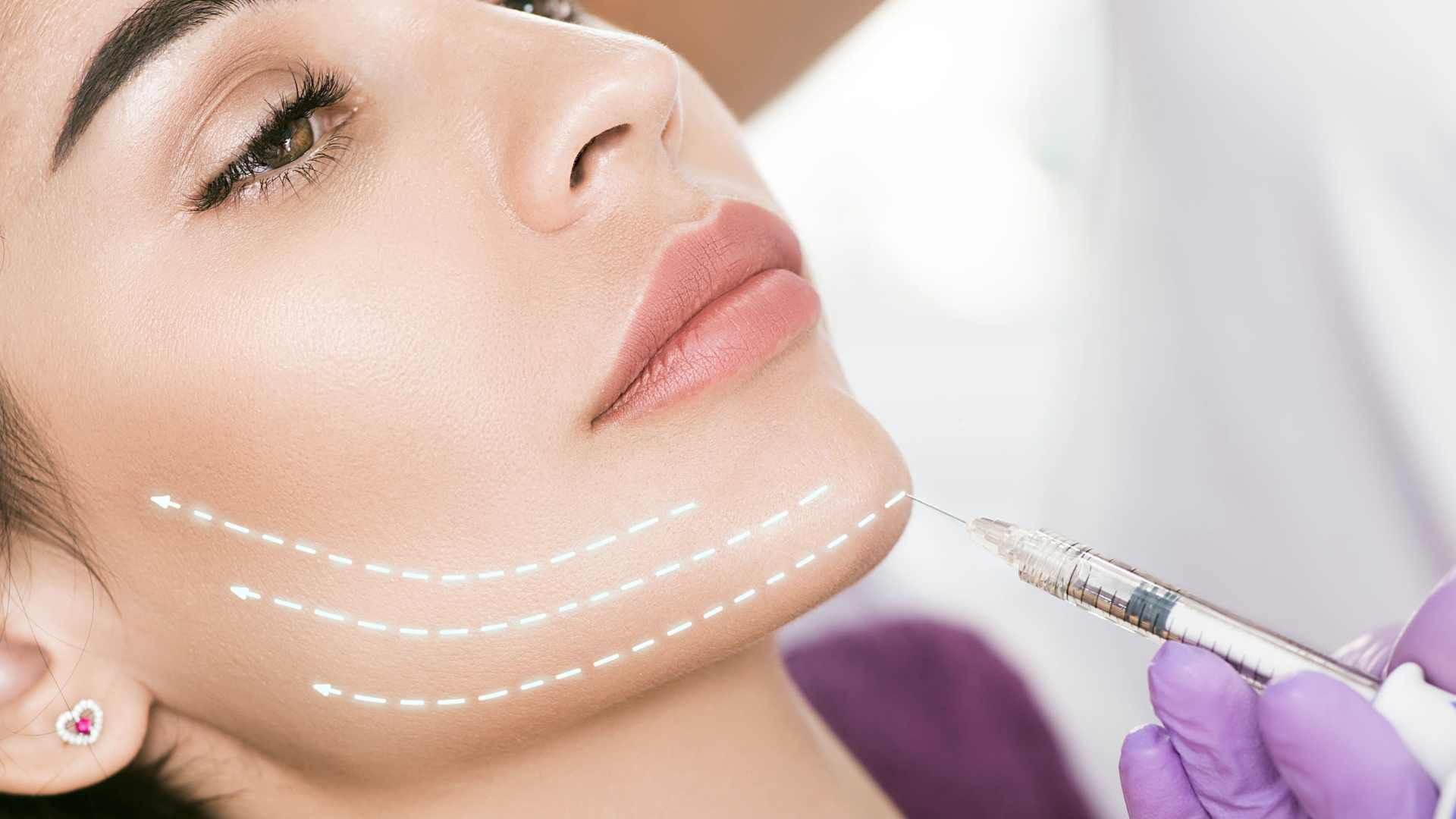 تزریق ژل جهت زاویه سازی صورت با برند آیدیا (1cc) دکتر آناهیتا هاشمی در کرج 1