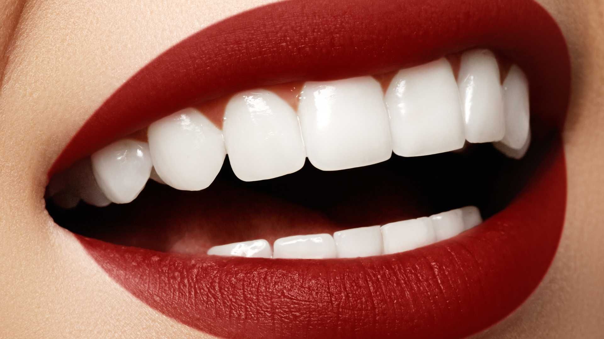 آفیس بلیچینگ (سفید کردن دندان) دو فک با مواد ایرانی