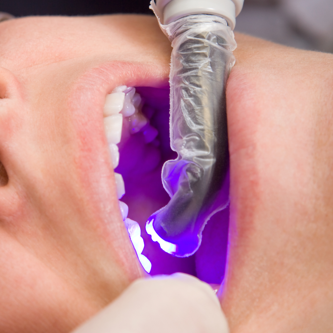 پرکردن دندان شیری یک سطحی با کامپوزیت آلمانی دکتر لیلا آذرنوش در تهران 1