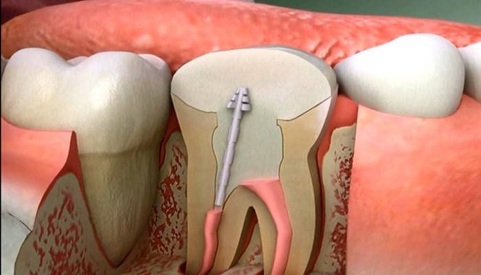 عصب درمانی مجدد (دندان های قدامی)