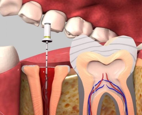 عصب درمانی مجدد (دندان های خلفی)