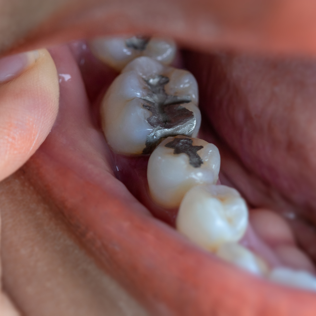 پرکردن دندان شیری سه سطحی با آمالگام دکتر لیلا آذرنوش در تهران 1