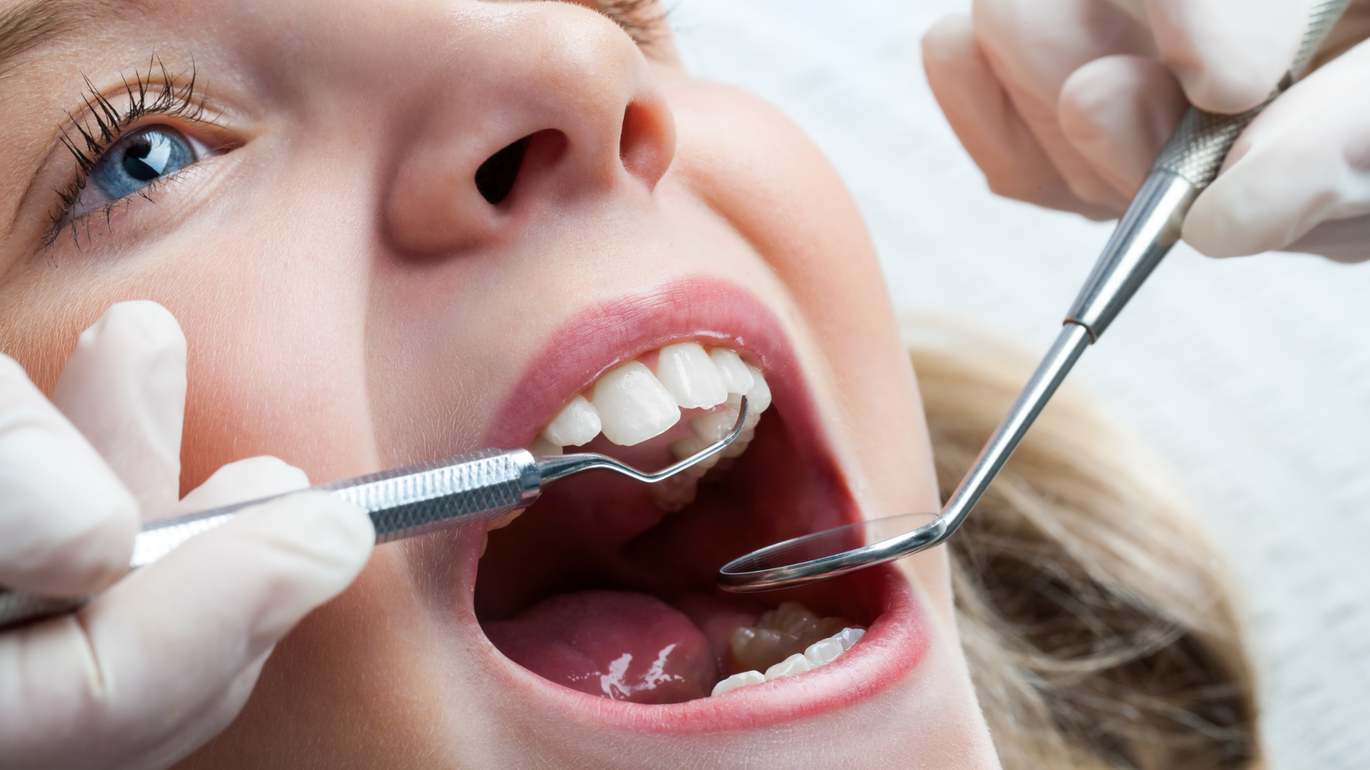 پالپکتومی دندان شیری (هر دندان)