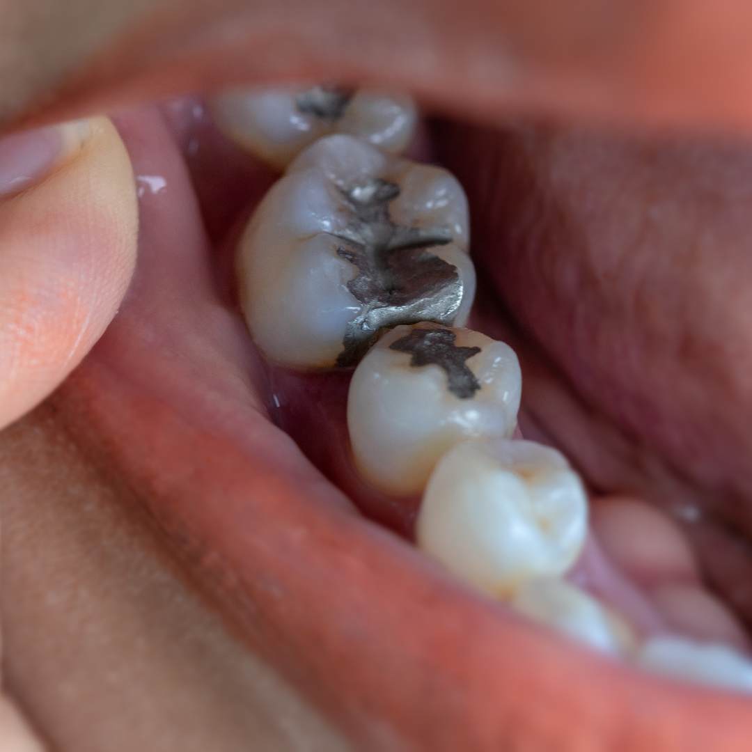 پرکردن دندان یک سطحی با آمالگام ایرانی دکتر علی سجودی خوشابی در تهران 1