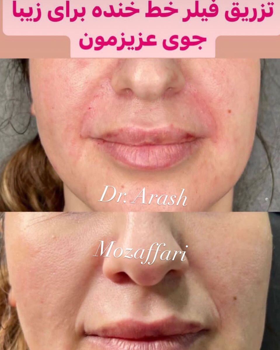 تزریق ژل کره ای (1cc)