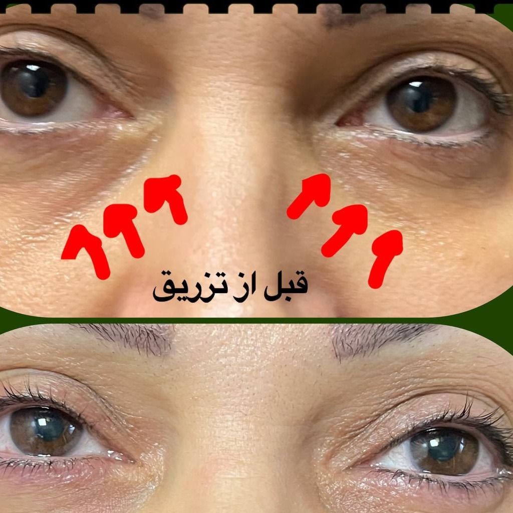 تزریق ژل زیر چشم با برند پلوریال لوکزامبورگ (1cc) دکتر مریم نساجی زواره در تهران 2