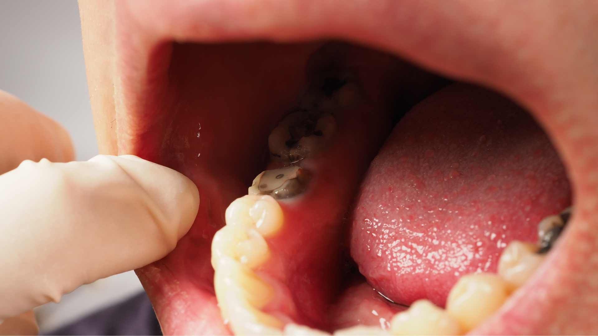 بیلدآپ (بازسازی) دندان با آمالگام ایرانی دکتر علی ناصح اعلم در کرج 1