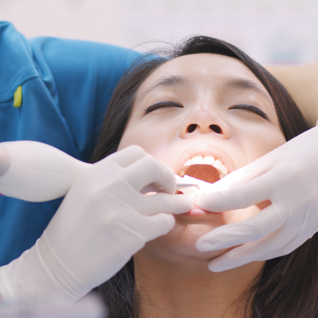 پرکردن دندان یک سطحی با آمالگام دکتر سید علی کمونه در کرج 1
