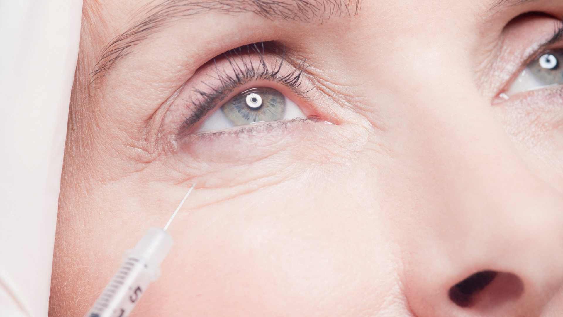 کاهش تیرگی و جوانسازی دور چشم به روش مزوتراپی با برند رویتاکر (1 جلسه) دکتر آناهیتا هاشمی در کرج 1