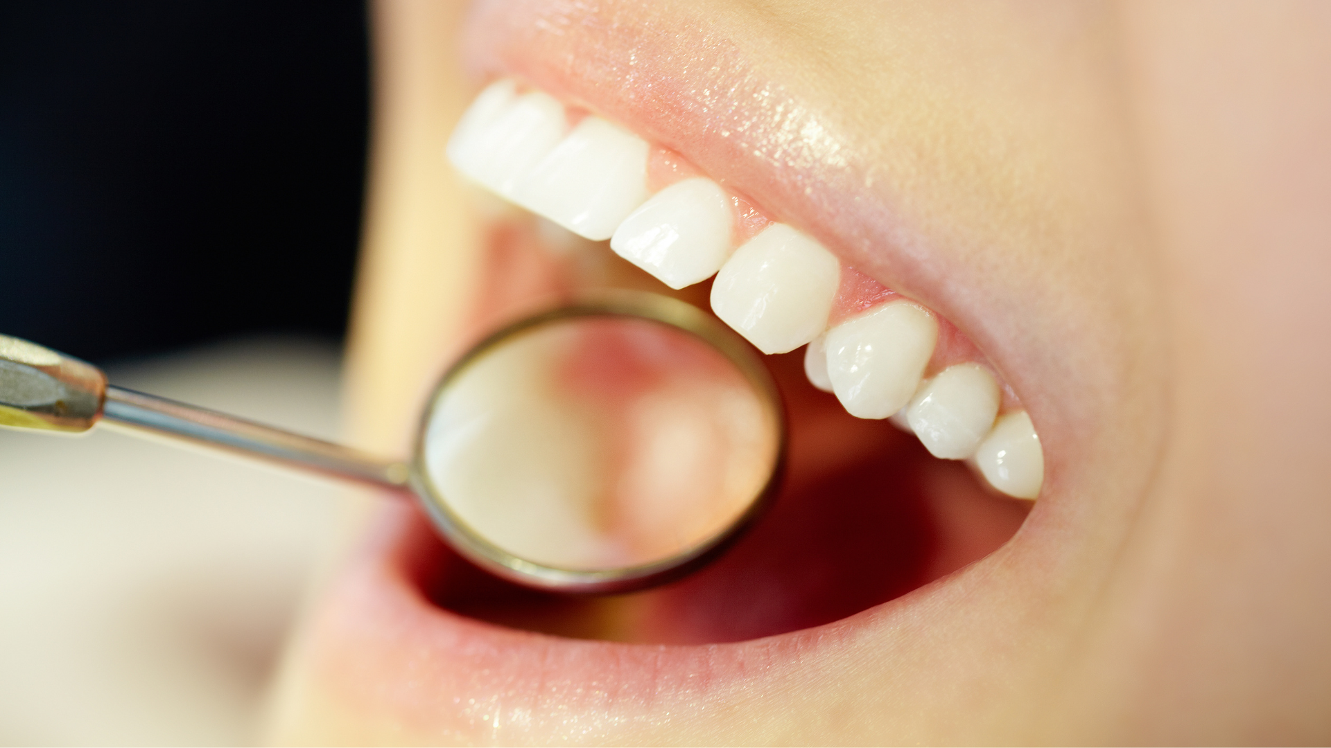 پرکردن دندان دو سطحی با کامپوزیت ژاپنی دکتر آزاده سیدمیرزائی در کرج 1