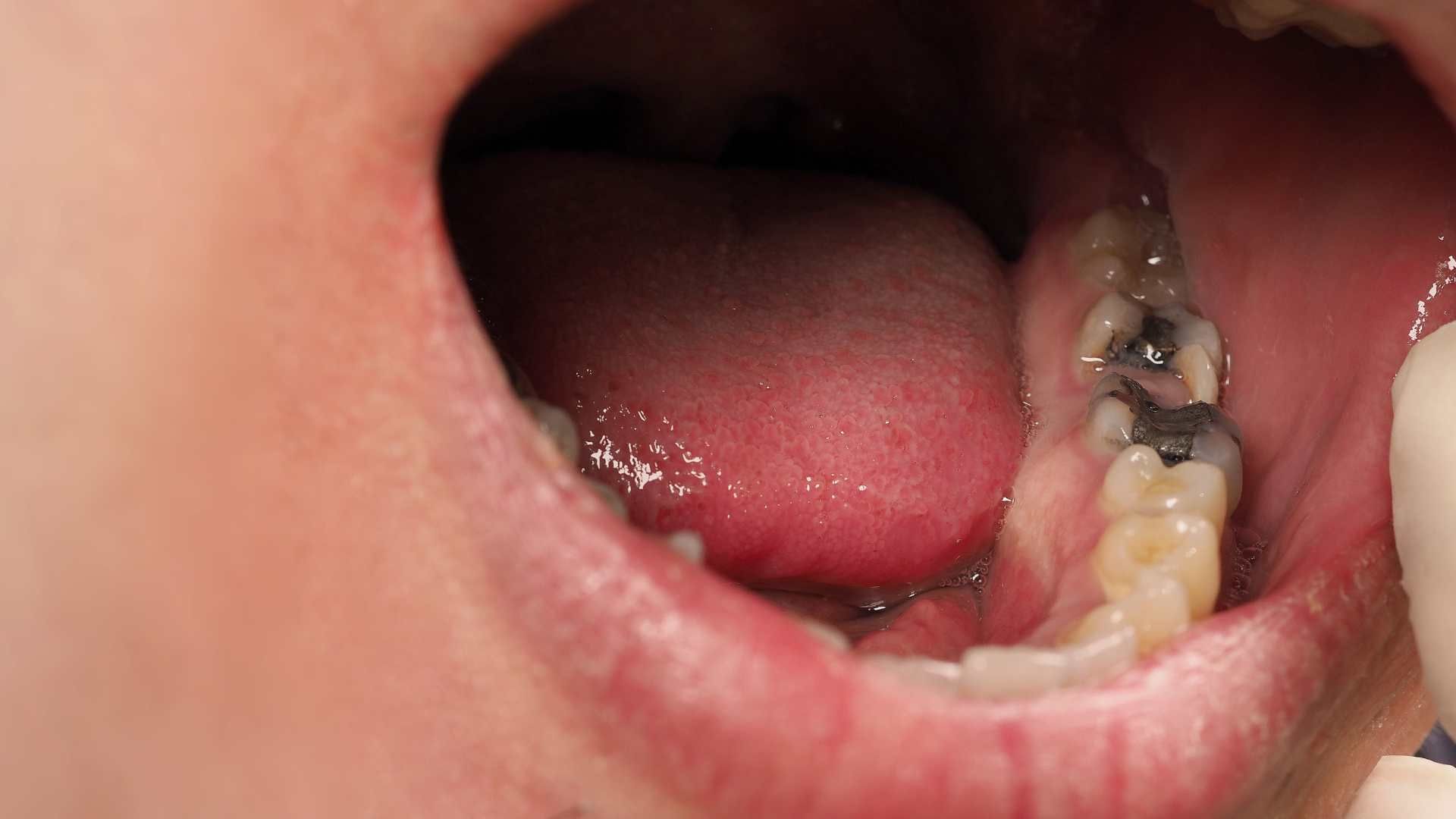 پرکردن دندان یک سطحی با آمالگام