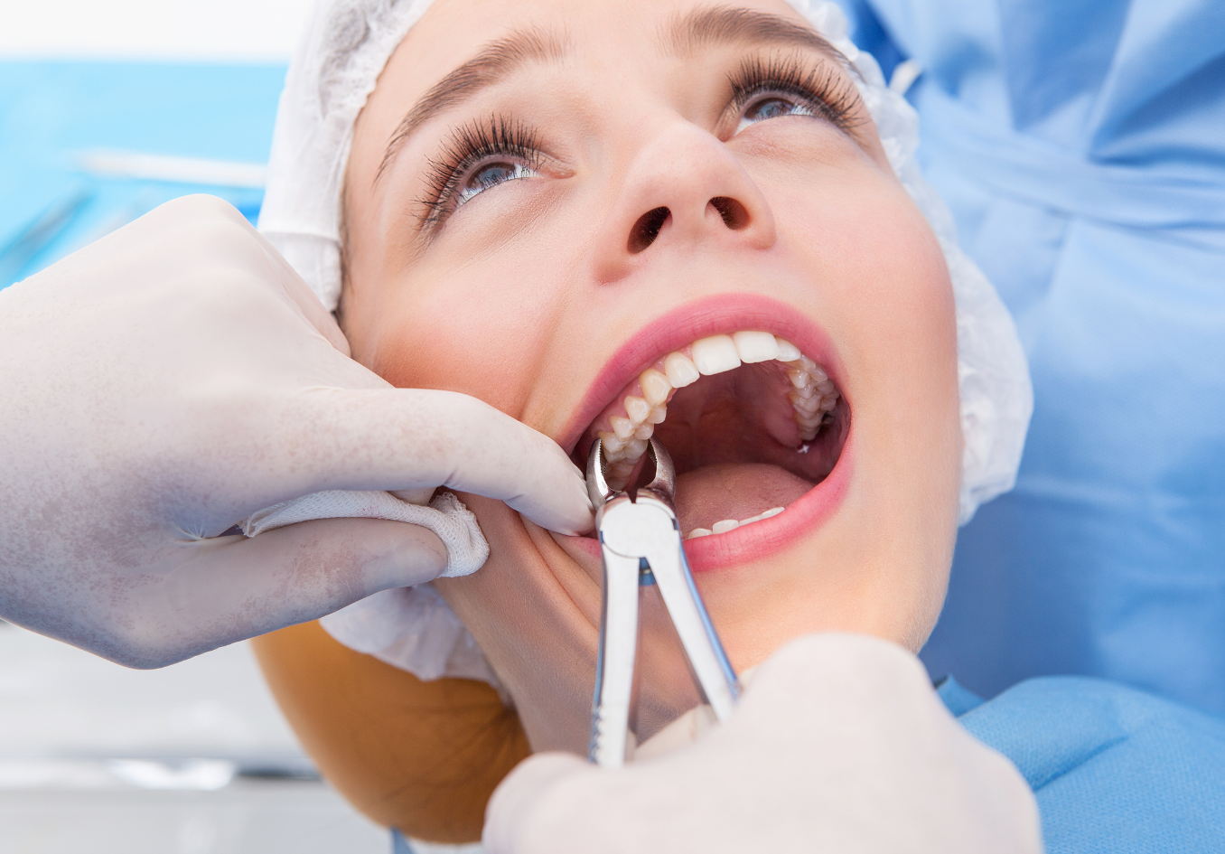 کشیدن دندان جلویی (بدون جراحی) دکتر فاطمه عرفانی زاده در شیراز 1