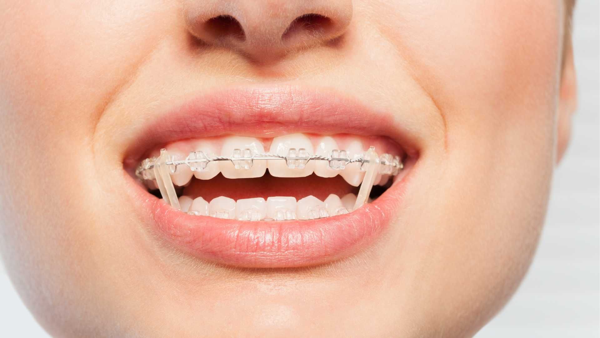 ارتودنسی با پلاک نامرئی (clear aligner) ( دو فک)( موقتا غیر فعال)