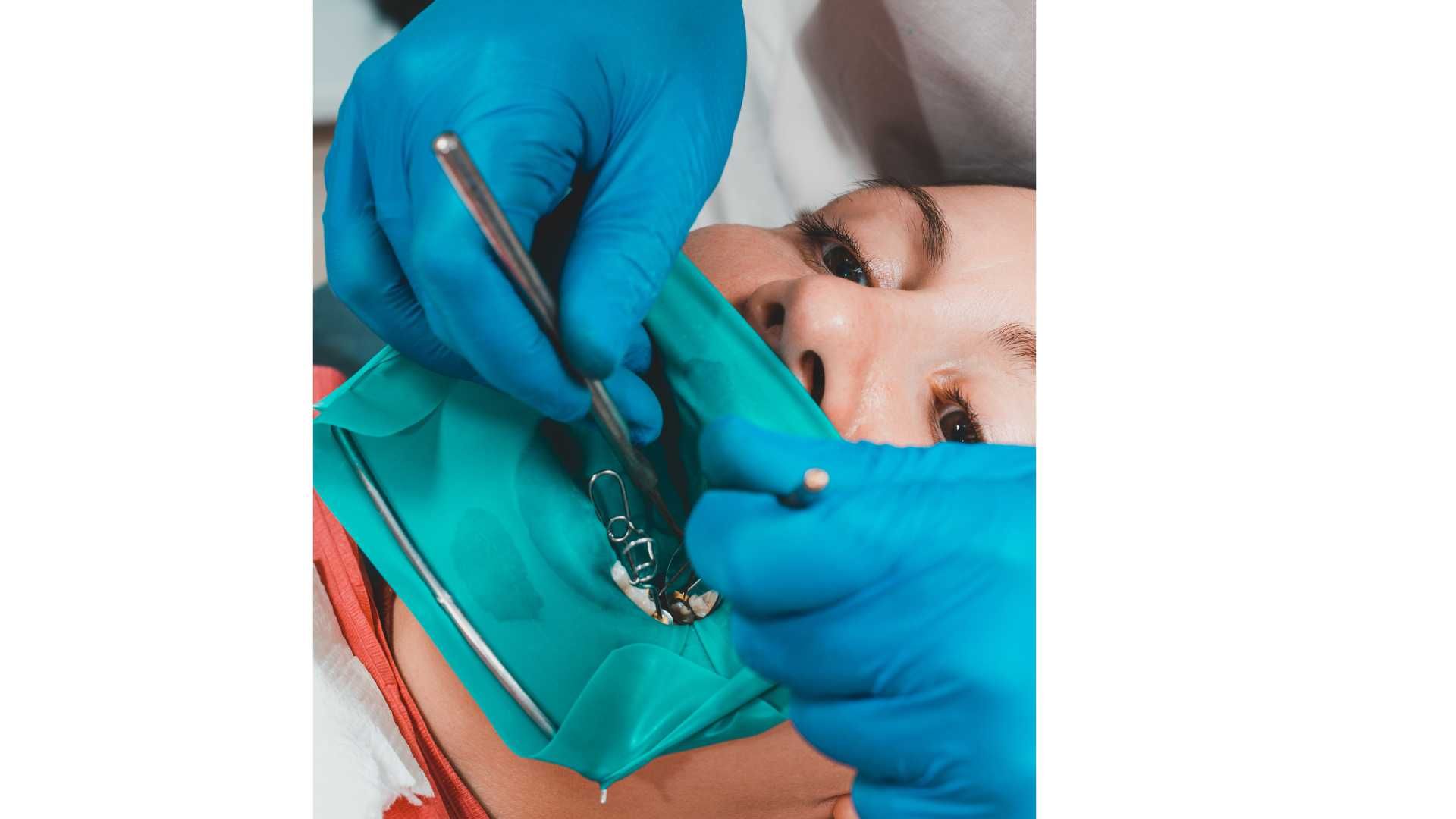 پرکردن دندان یک سطحی با آمالگام ایرانی