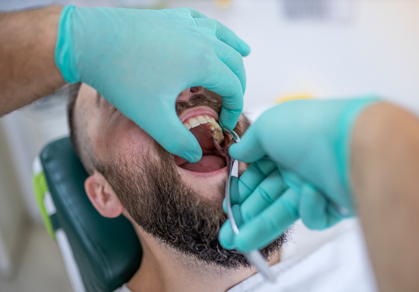 کشیدن دندان عقبی (بدون جراحی)