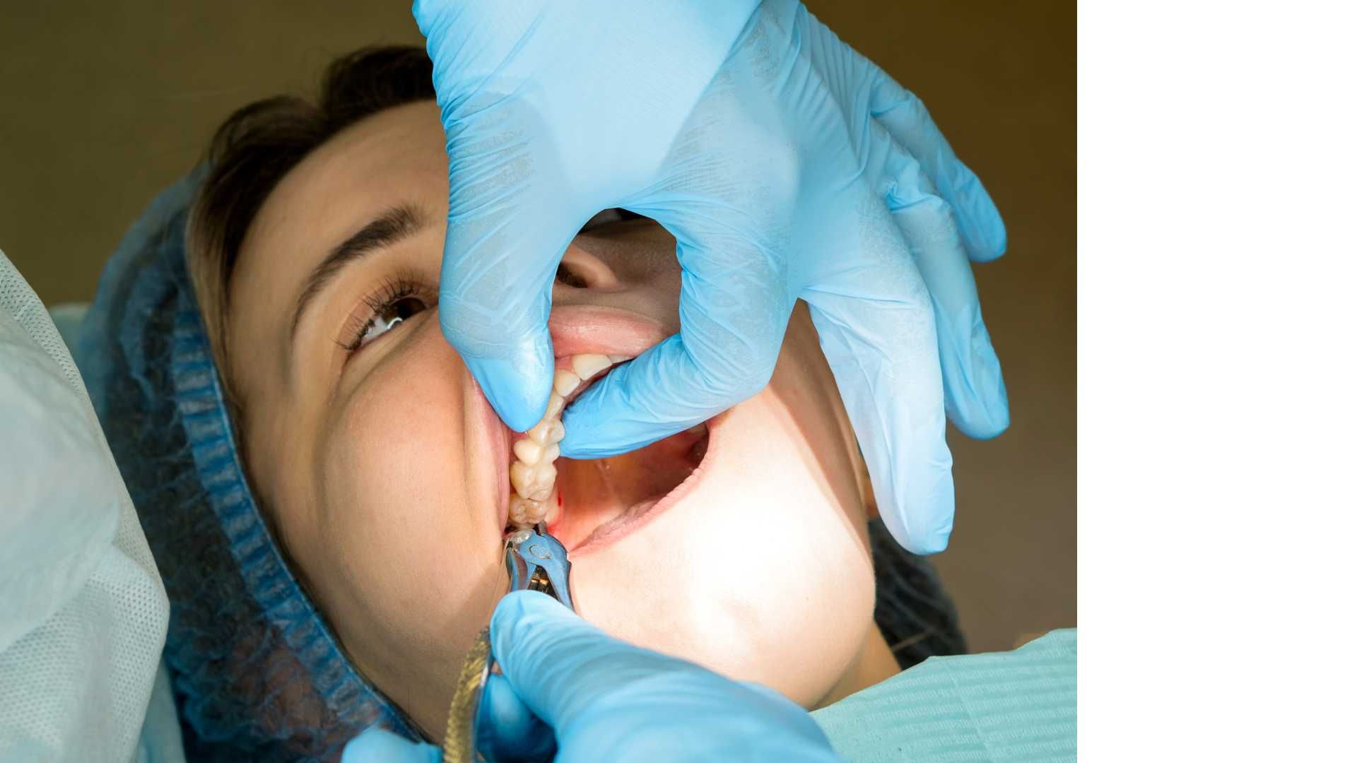 کشیدن دندان خلفی بدون جراحی
