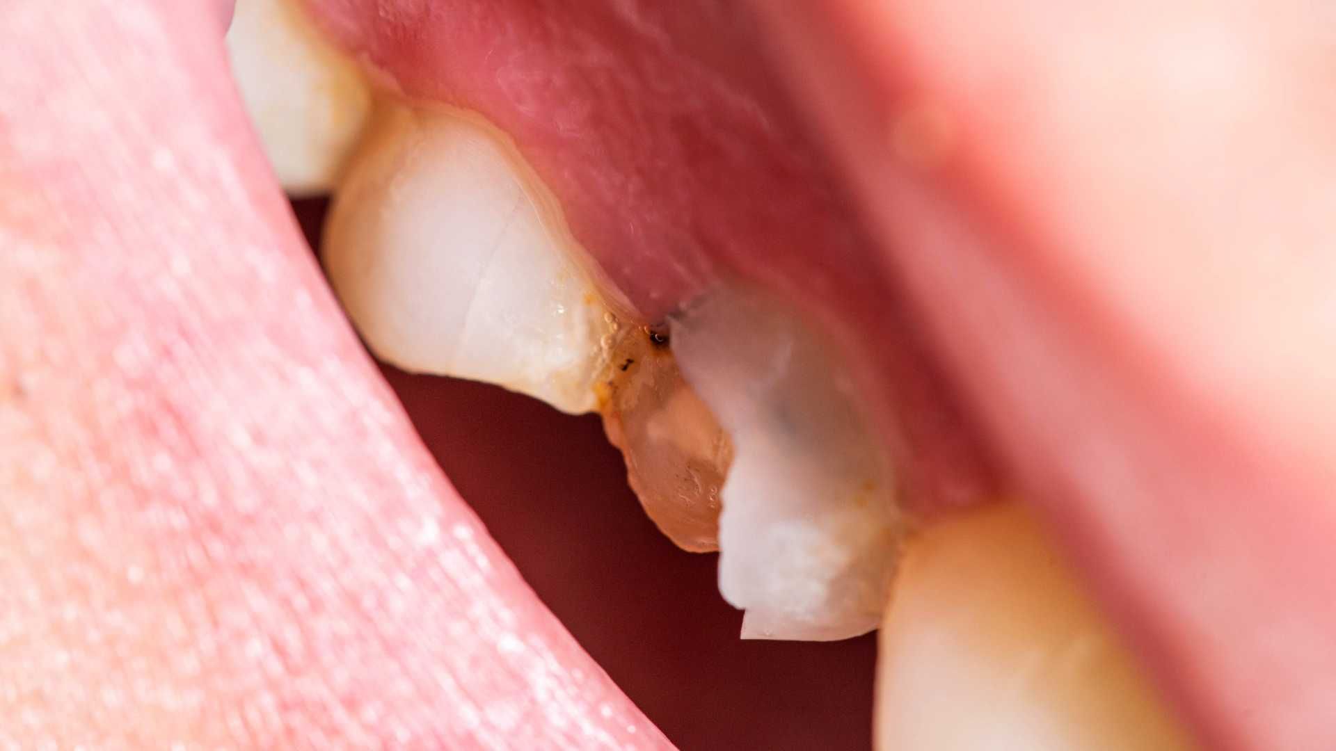 پرکردن دندان یک سطحی با آمالگام دکتر علی باذلی در تهران 1