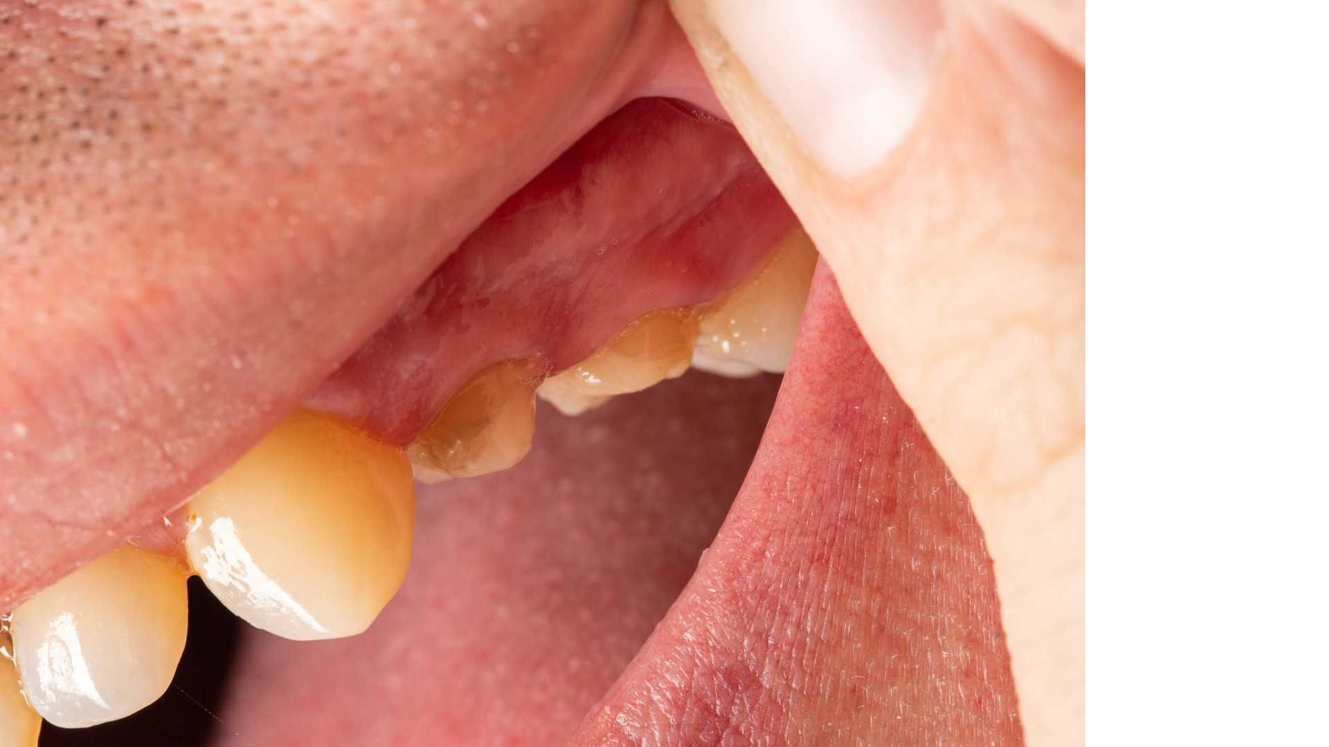 پرکردن دندان سه سطحی با آمالگام ایرانی دکتر امیر نجف زاده در شیراز 1