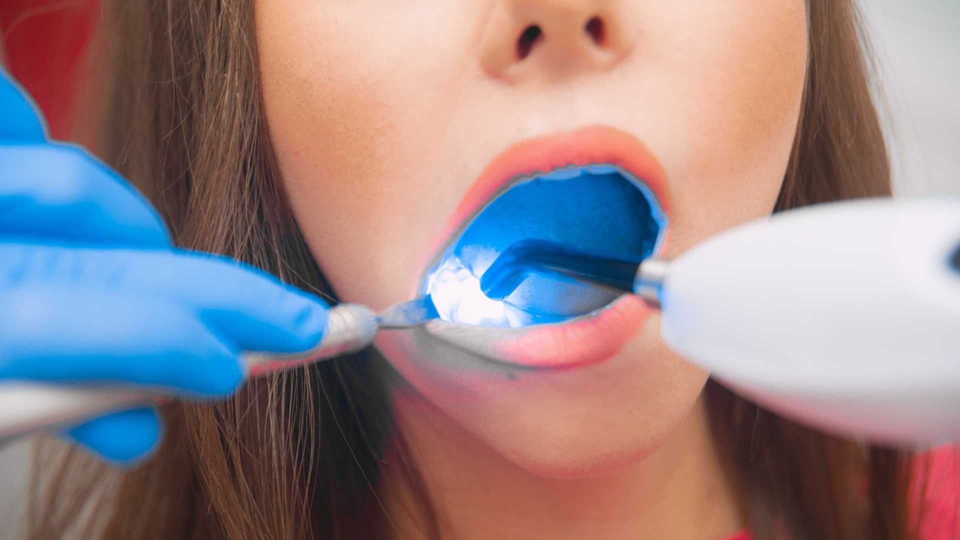 پرکردن دندان یک سطحی با کامپوزیت ژاپنی