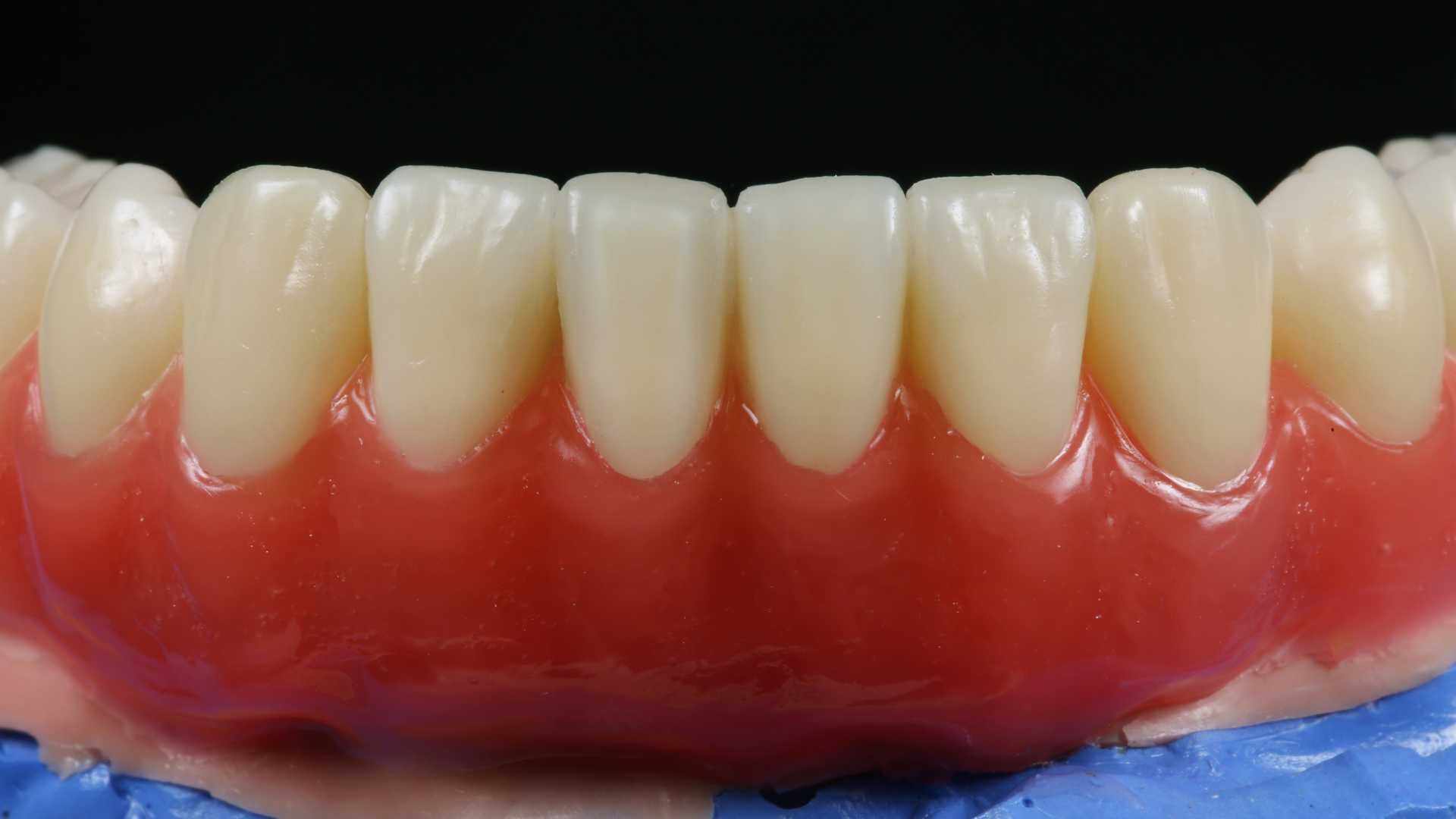دندان پروتز متحرک پارسیل (دندان مصنوعی تکه ای) فلکسی (یک فک)