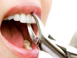 کشیدن دندان جلویی (بدون جراحی) دکتر سید علی کمونه در کرج 1