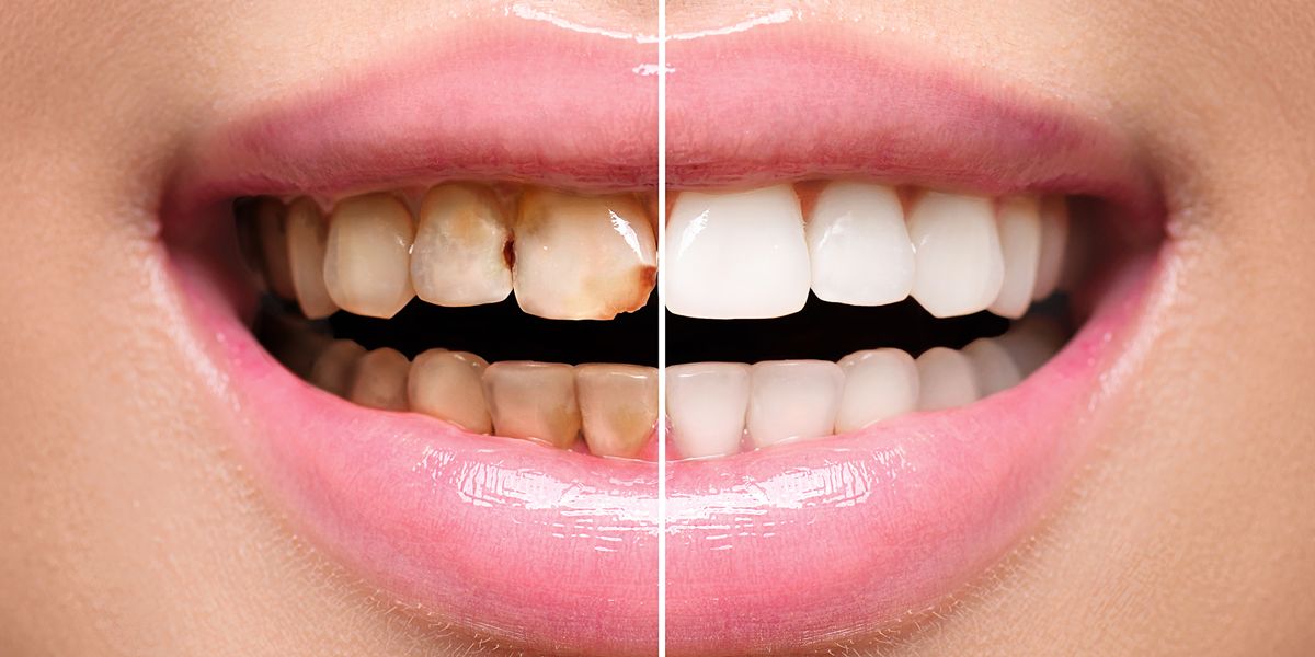 پرکردن دندان شیری یک سطحی با کامپوزیت ژاپنی