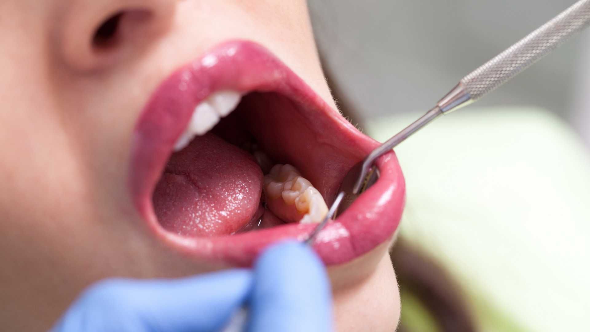 پرکردن دندان یک سطحی با کامپوزیت ژاپنی