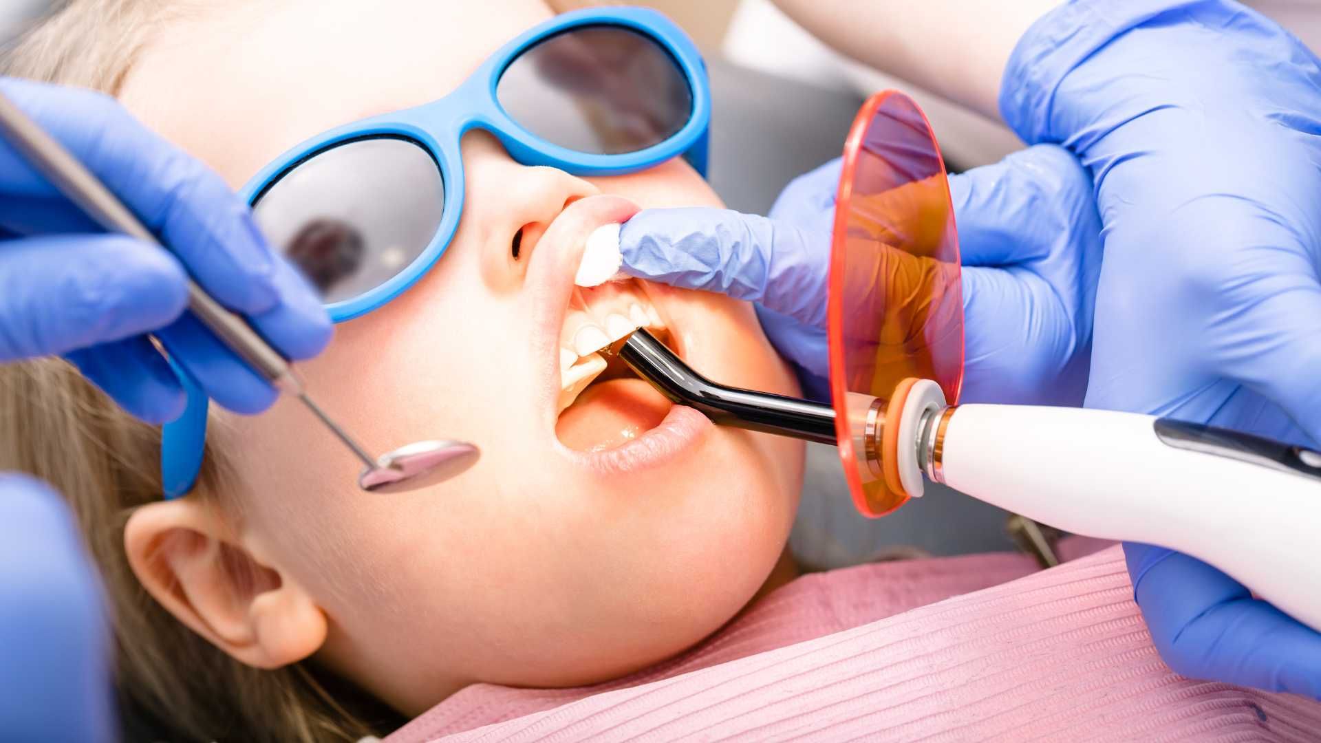 پر کردن دندان شیری سه سطحی با کامپوزیت آلمانی