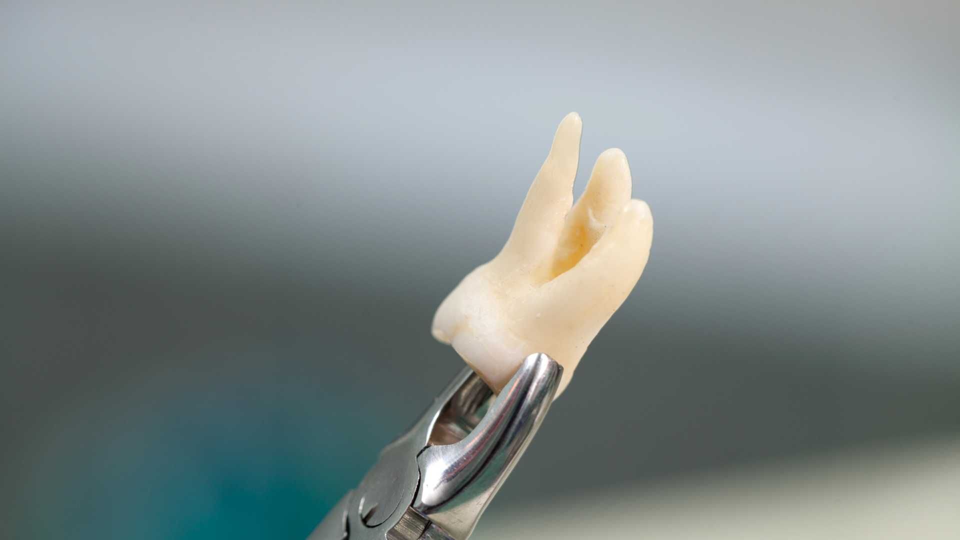 کشیدن دندان خلفی (بدون جراحی)