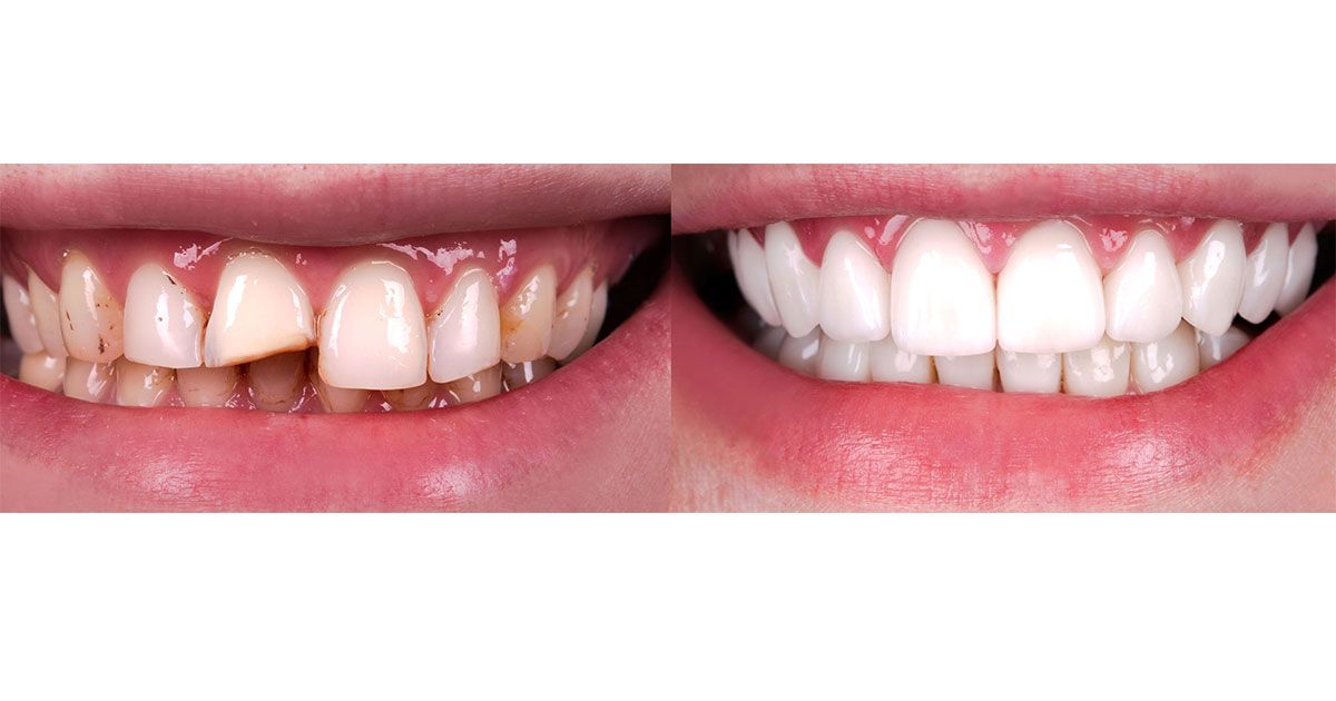 پرکردن دندان دو سطحی با کامپوزیت کره ای (هر واحد)
