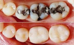 پرکردن دندان سه سطحی با آمالگام ایرانی دکتر آزاده سیدمیرزائی در کرج 1