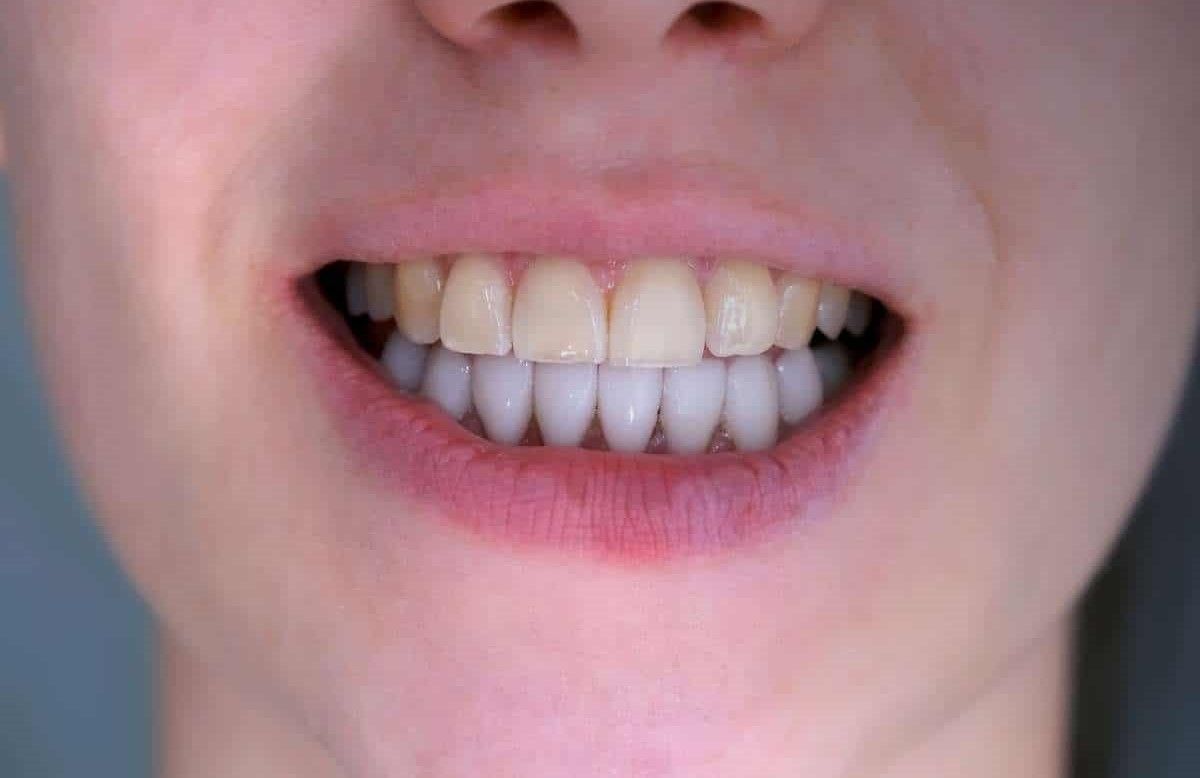 پرکردن دندان شیری سه سطحی با کامپوزیت ژاپنی دکتر آزاده سیدمیرزائی در کرج 1